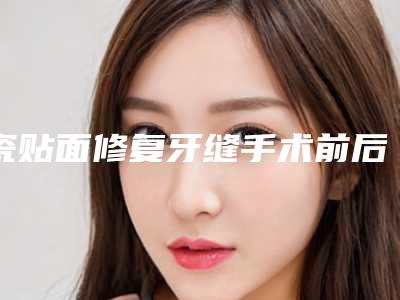 瓷贴面修复牙缝手术前后的效果对比
